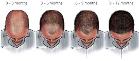 finasteride timeline|Finasteride Results Timeline: What to Expect .